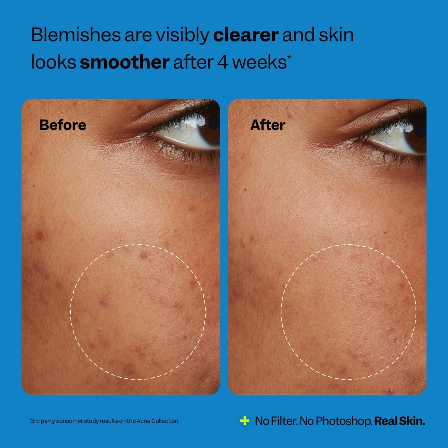 Peach Slices | Acne Oil-Free Moisturizer | Satin Matte Finish | 0.5% Salicylic Acid | Hyaluronic Acid | Prevents Breakouts | Pore Minimizing | Clear Skin | Silicone Free | Face Moisturizer | 2.8 oz